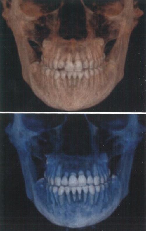 正畸治疗为何引发牙根吸收?如何预防与处理?-图1 正畸治疗为何引发牙根吸收?如何预防与处理?-图1