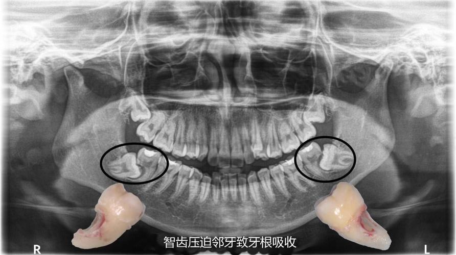 正畸治疗为何引发牙根吸收?如何预防与处理?-图2 正畸治疗为何引发牙根吸收?如何预防与处理?-图2