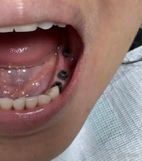 有牙周病能正畸吗-图3