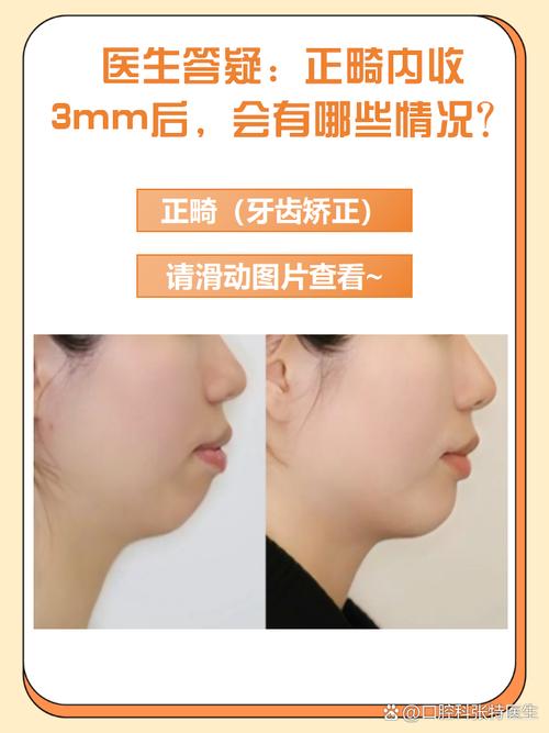 正畸内收过度图片-图2