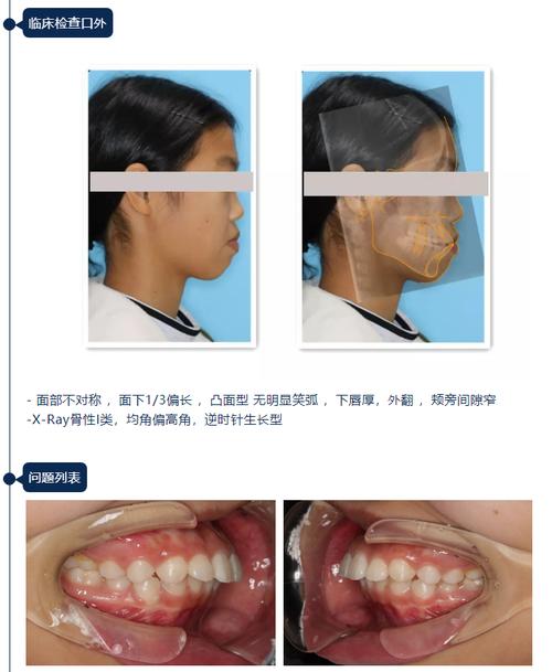 安氏类错颌正畸，不同类型的矫治重点有何不同？-图2