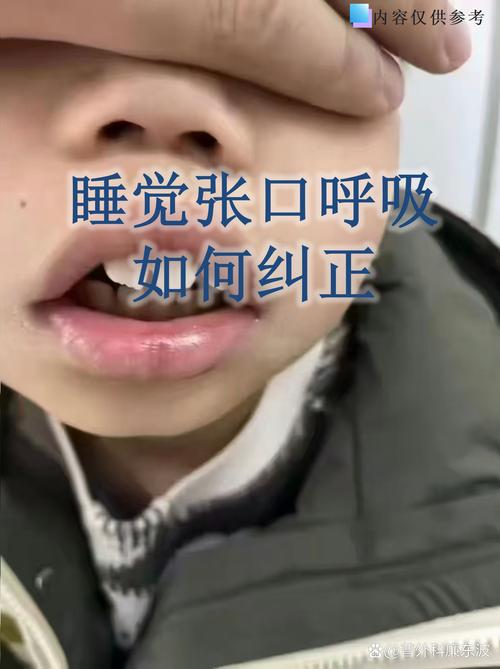 口腔正畸科口呼吸-图2
