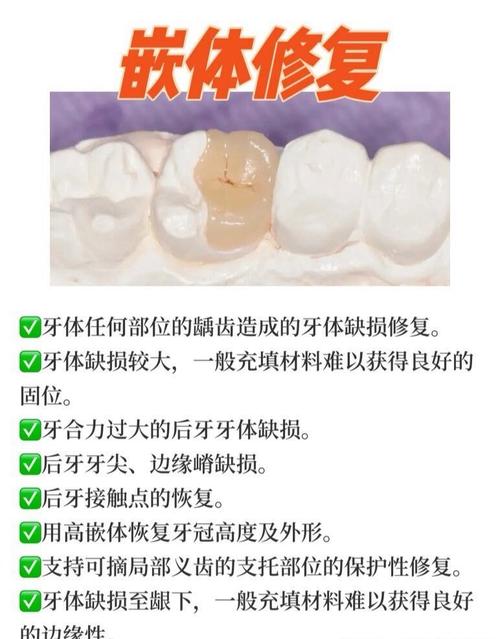 正畸中能做嵌体吗-图2