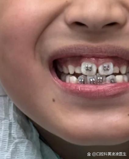 正畸后牙根歪斜，究竟是什么原因导致的？-图3