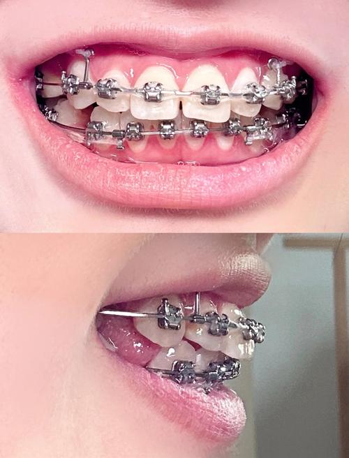 正畸拔牙不打骨钉-图1