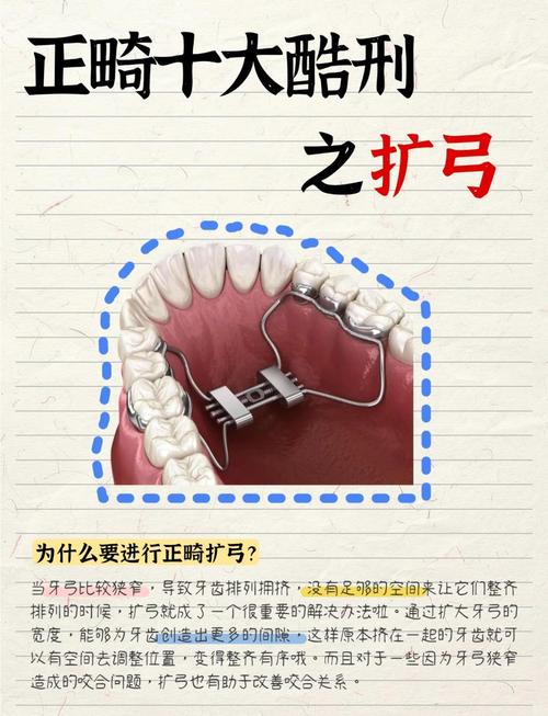 正畸扩弓怎么操作-图1