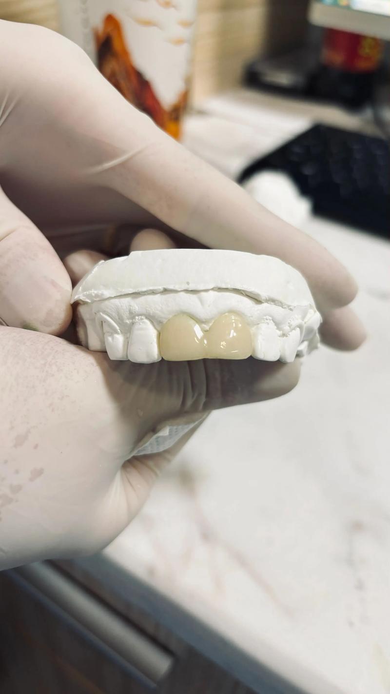 临时冠能支撑正畸-图1