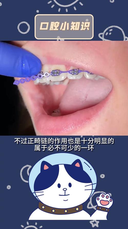 正畸橡皮链的清洁-图1