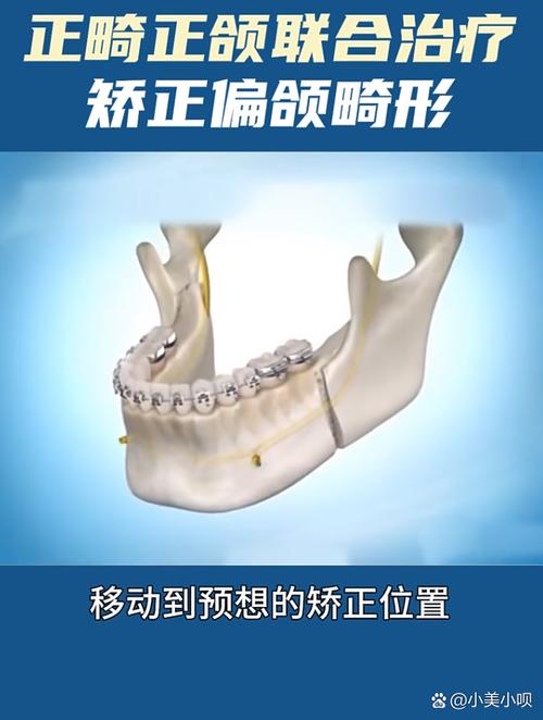 正颌正畸在线咨询靠谱吗？效果如何？-图3