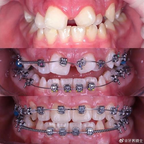 正畸要拍什么照片-图2