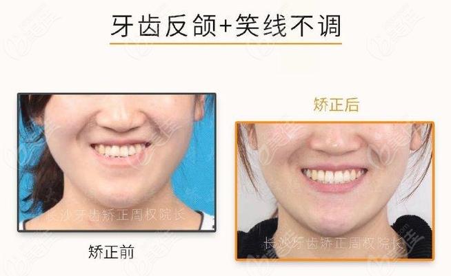 周权正畸什么水平-图1