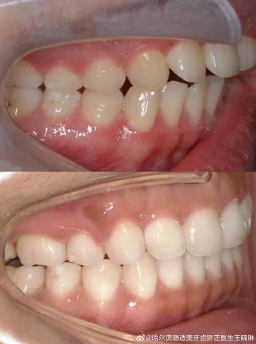 正畸之后去了外地-图1