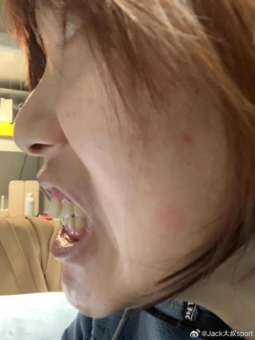 正畸之后去了外地-图2