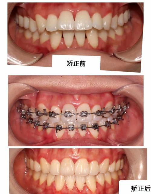 正畸摄影照片翻转-图1 正畸摄影照片翻转-图1