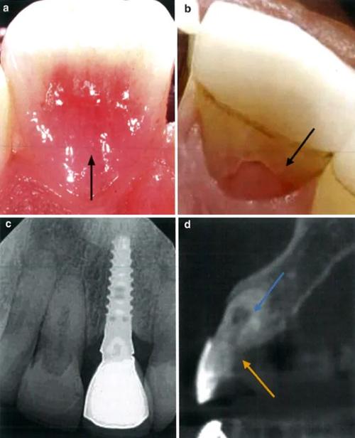 正畸炎症牙根吸收-图1