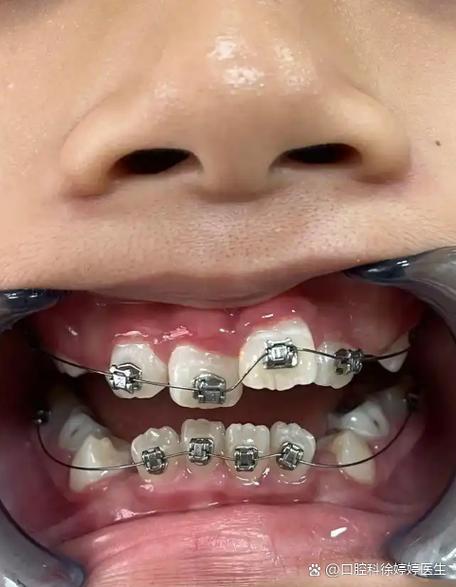 常州隐形透明正畸-图2 常州隐形透明正畸-图2