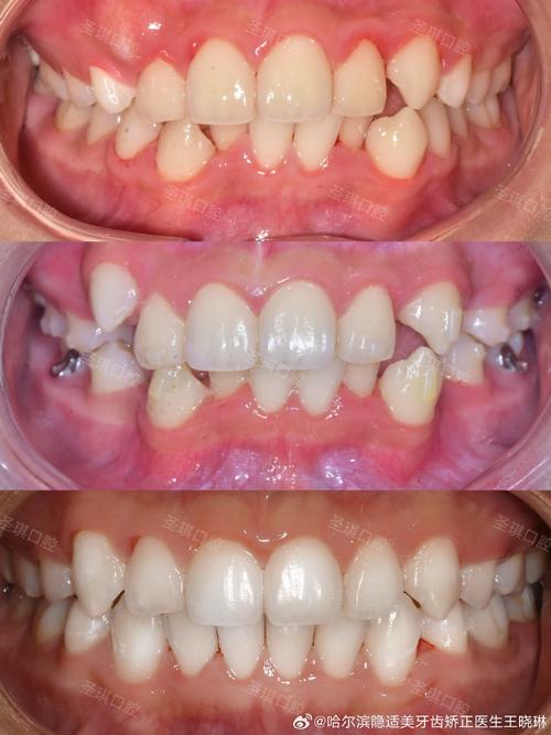 正畸牙齿为何会拥挤？如何有效改善矫正效果？-图1