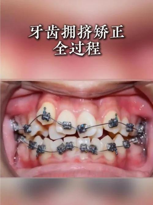 正畸牙齿为何会拥挤？如何有效改善矫正效果？-图2