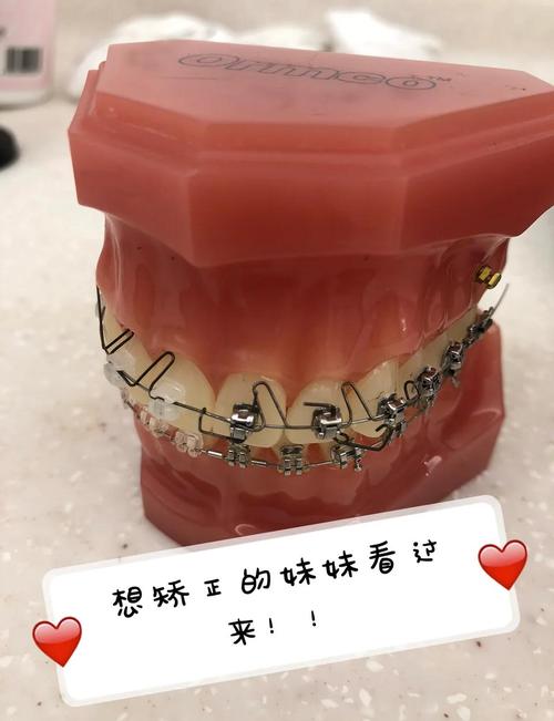 透明托槽正畸效果如何？隐形美观舒适度靠谱吗？-图1