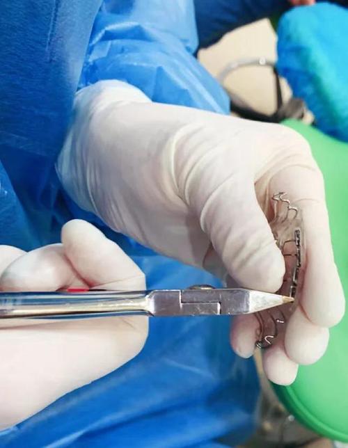 牙床高低正畸手术-图2