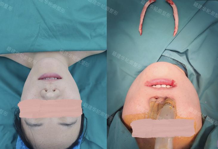 牙床高低正畸手术-图3