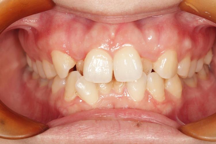 口腔正畸 拥挤度-图1