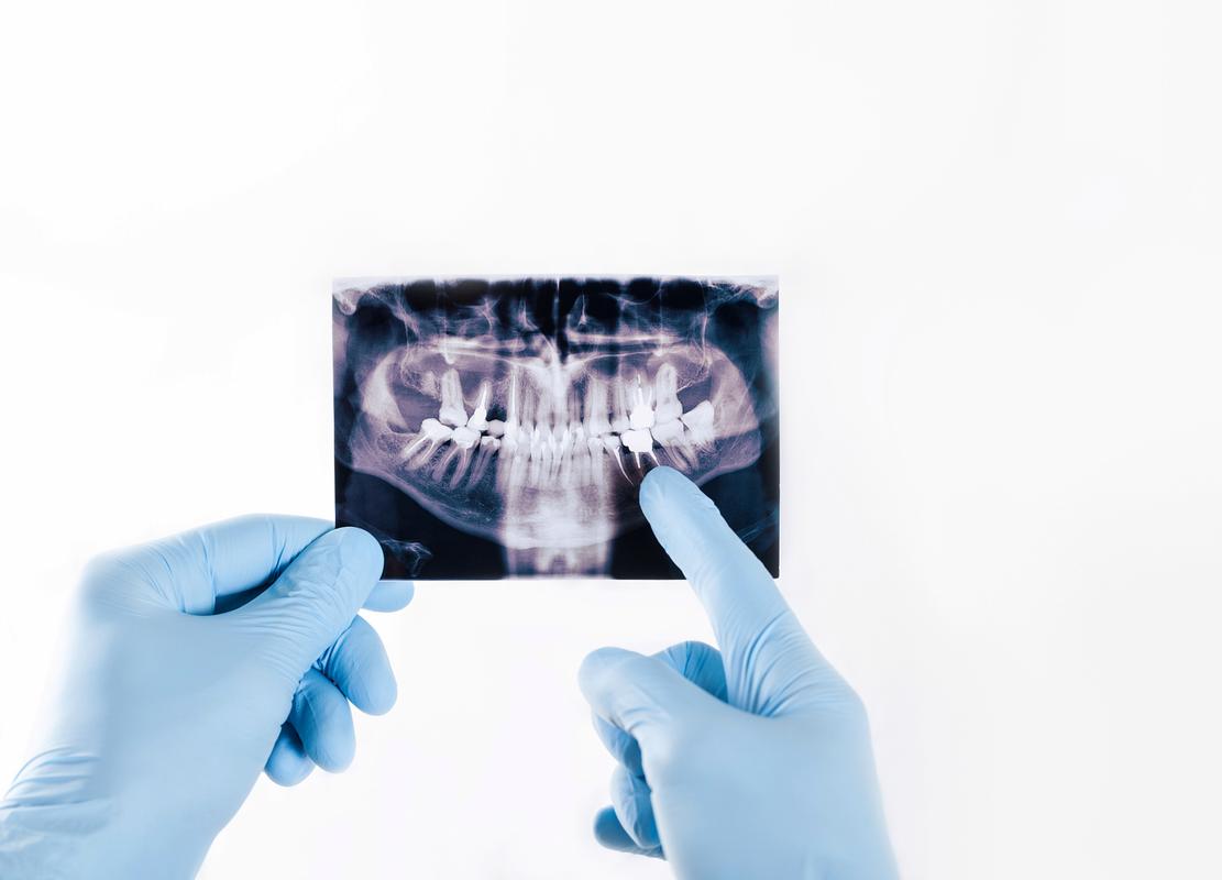 数字隐形正畸，如何兼顾美观与矫正效果？-图2