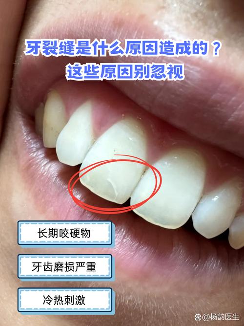 正畸期间牙齿裂开-图1