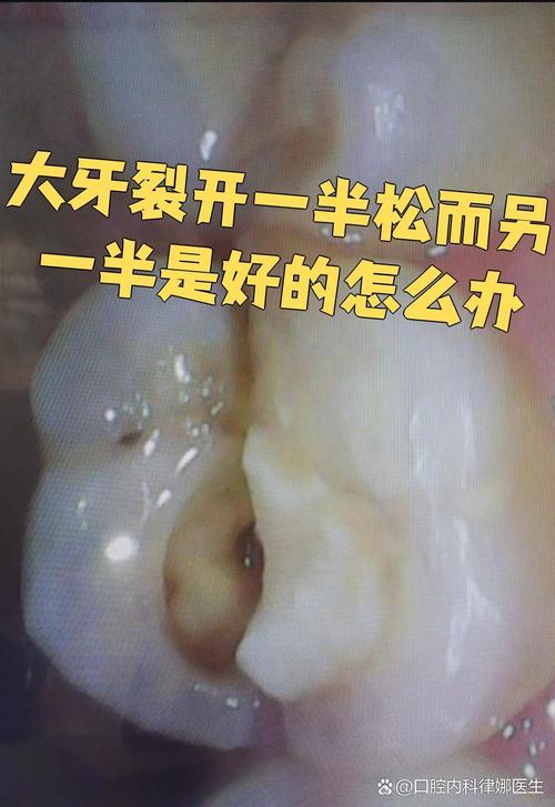 正畸期间牙齿裂开-图2