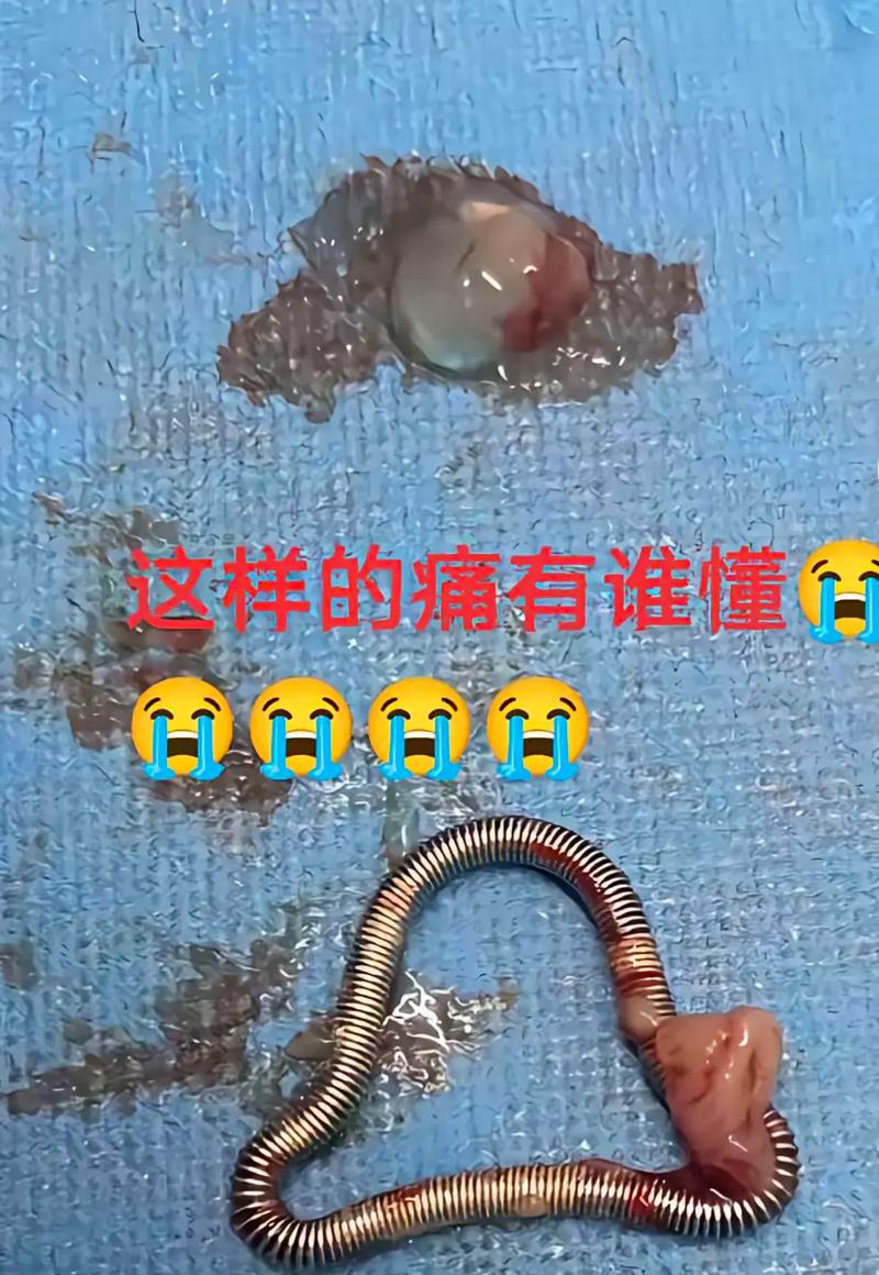 正畸牙齿带环掉了-图1 正畸牙齿带环掉了-图1