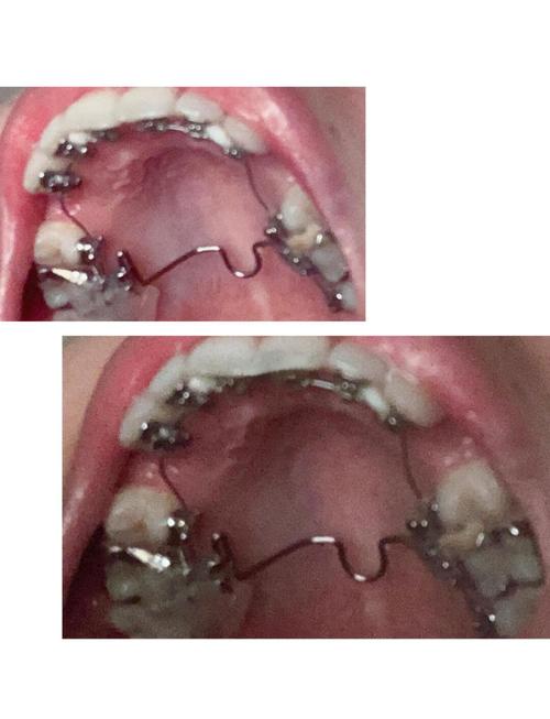 温州口腔正畸手术效果如何？安全靠谱吗？-图1