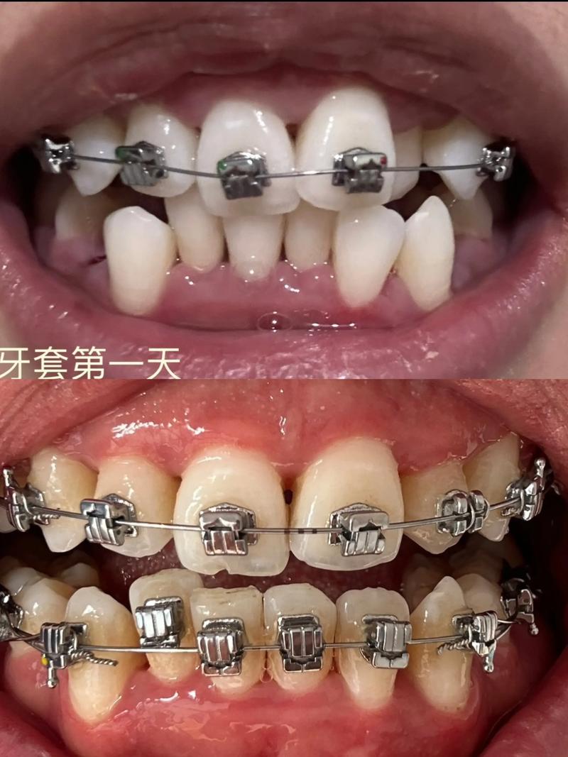 正畸矫正牙齿，过程中牙齿会有什么感受？-图2