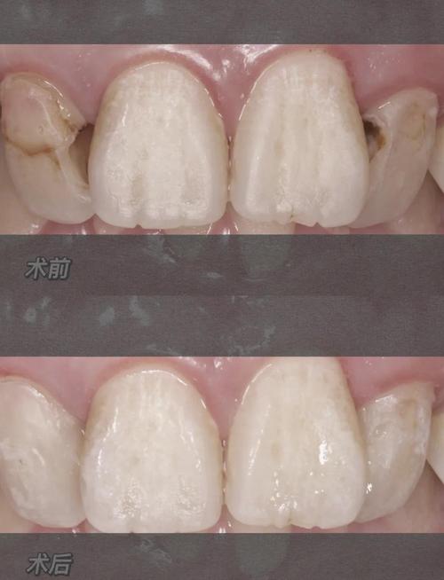 唇腭裂正畸 胶带-图2 唇腭裂正畸 胶带-图2