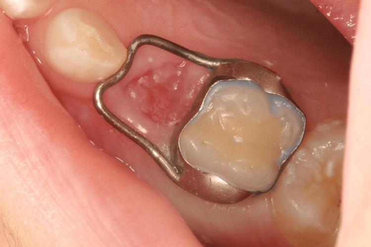 口腔正畸间隙关闭-图1