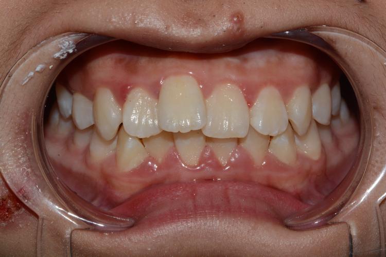 局部正畸 不全口-图1