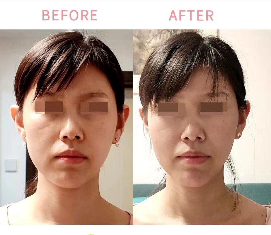 正畸导致下颌偏斜-图2