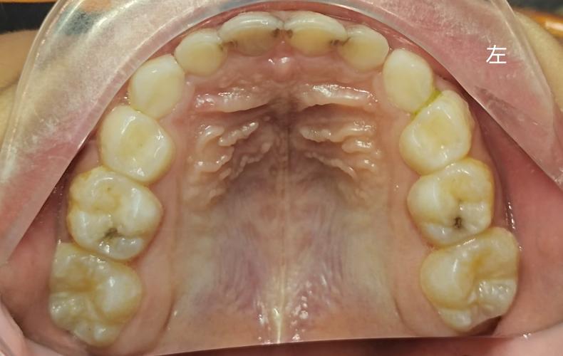 正畸为何刺激口腔黏膜？如何缓解不适？-图1