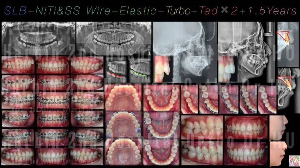 正畸为何刺激口腔黏膜？如何缓解不适？-图2
