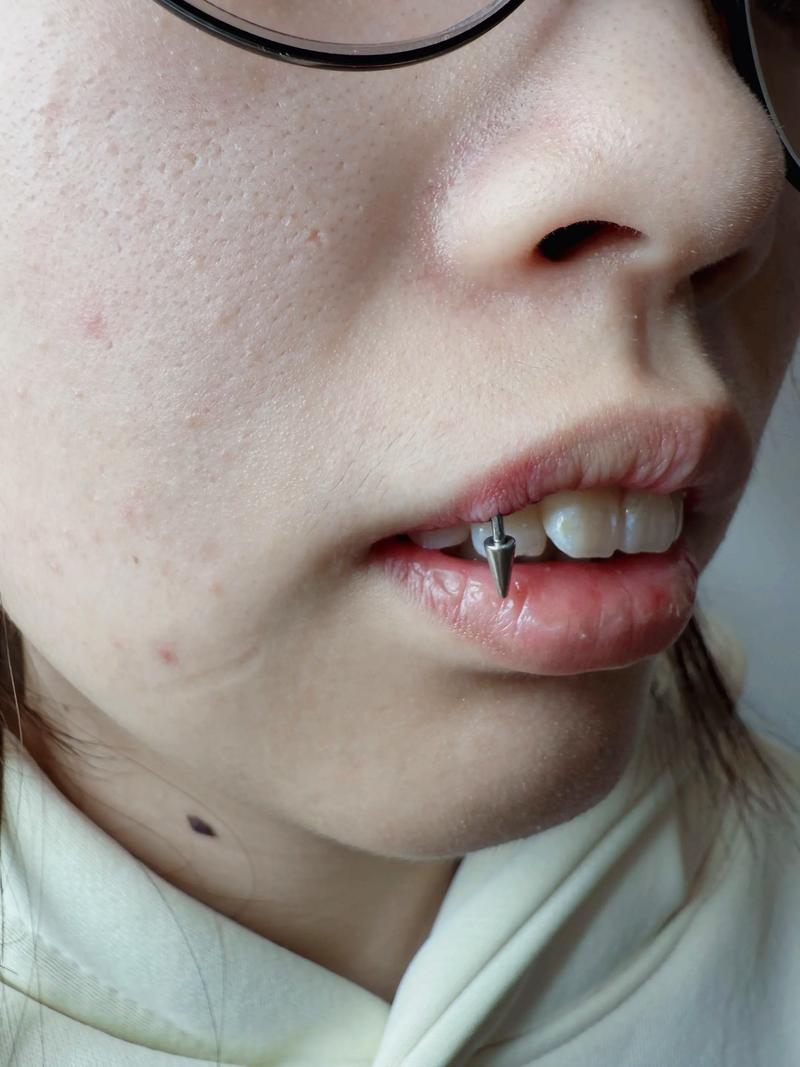 正畸种植钉 出血-图1