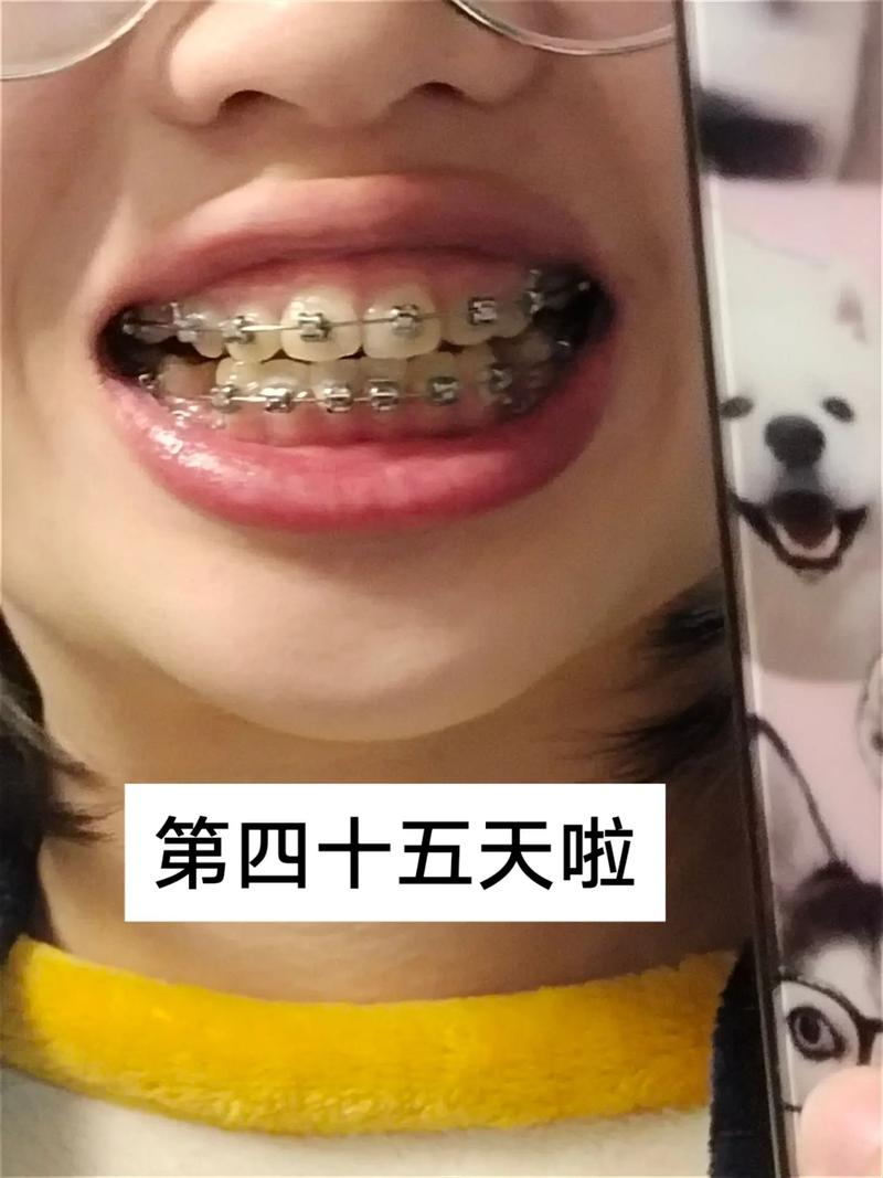 正畸完 后 牙缝-图1