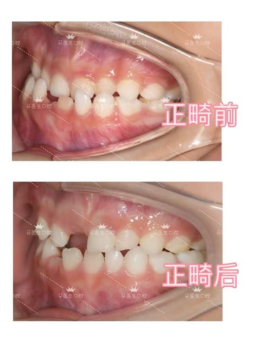 正畸完 后 牙缝-图3