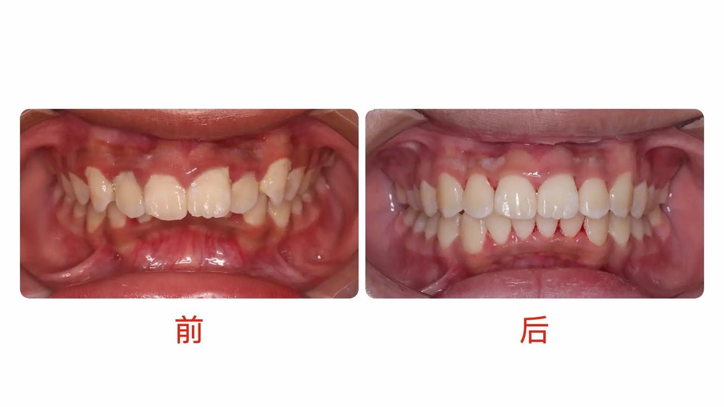 正畸优秀病例分享-图2