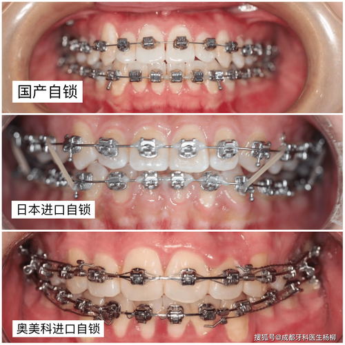 成都LH正畸法效果如何？适合哪些牙齿矫正需求？-图2