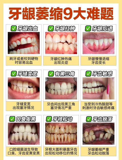 牙龈萎缩原因正畸-图1 牙龈萎缩原因正畸-图1