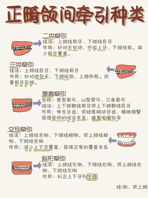 正畸颌间牵引定义-图2