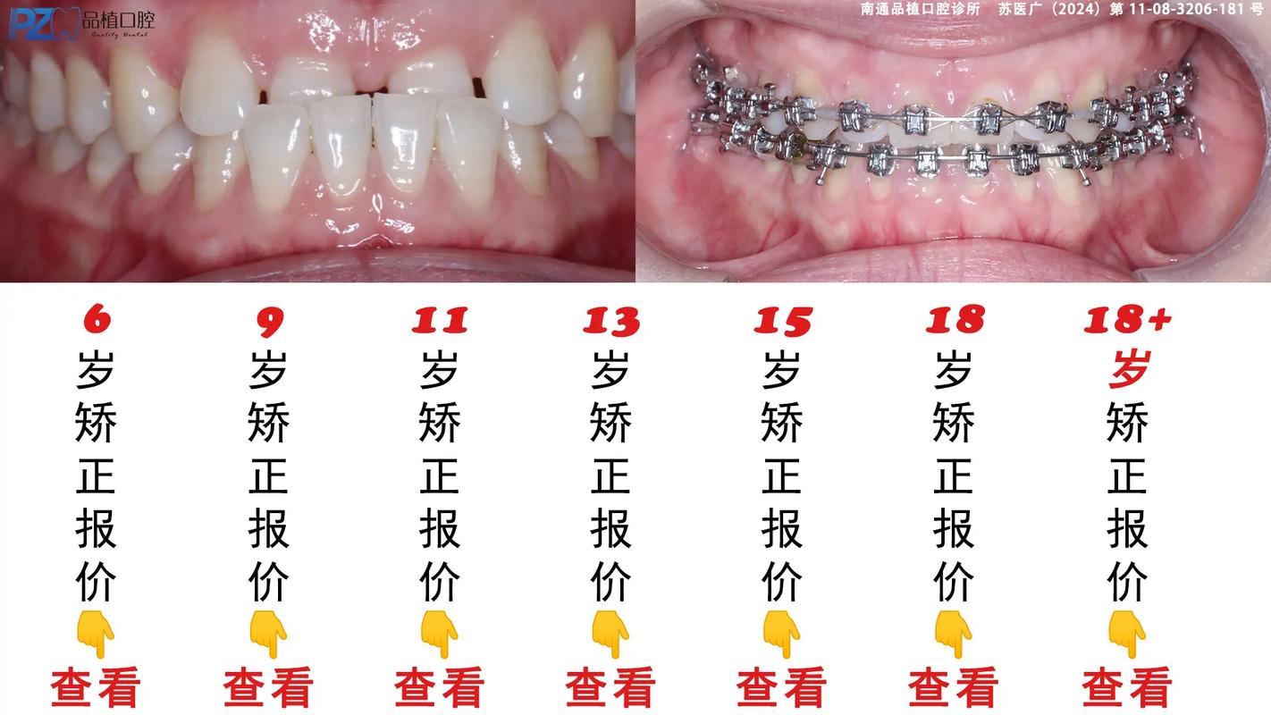 正畸中牙齿宽度测量为何是矫正的关键环节？-图3