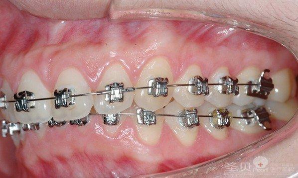 正畸托槽左右贴反-图3