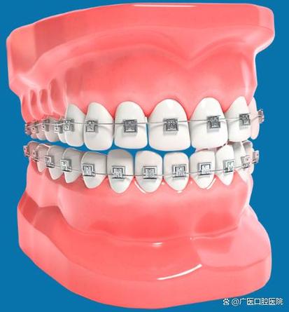 牙齿正畸带环缺点有哪些？矫正中需警惕哪些问题？-图1
