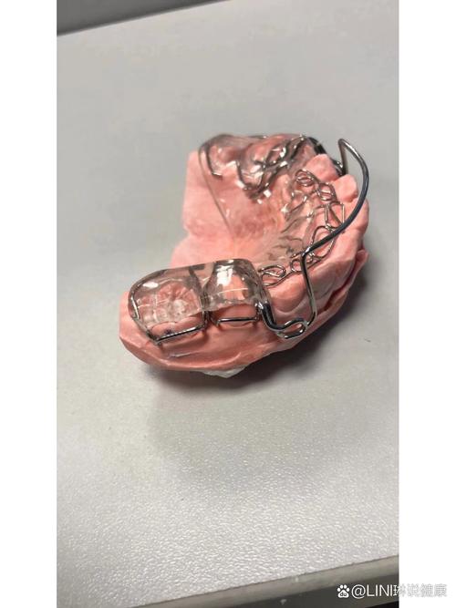 begg正畸辅弓-图2