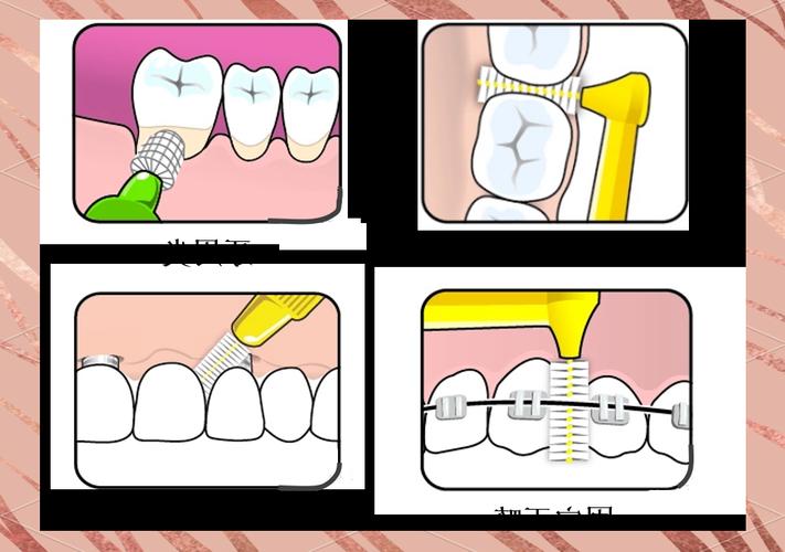 正畸清理牙齿工具-图3